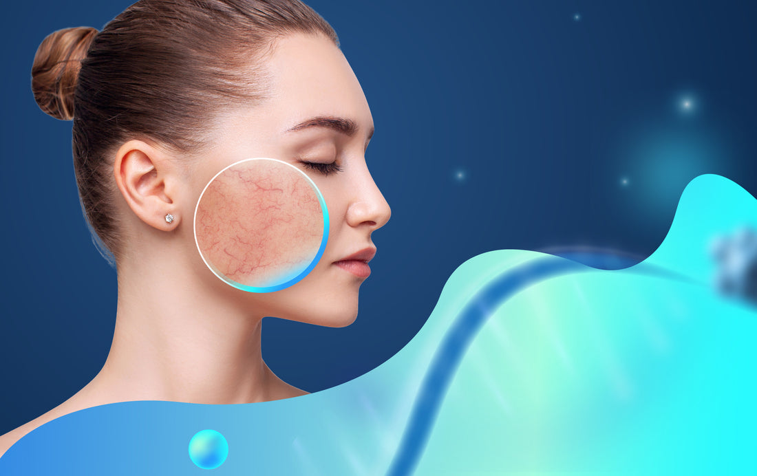 The Gut-Skin Axis: Is There A Connection Between SIBO and Rosacea?